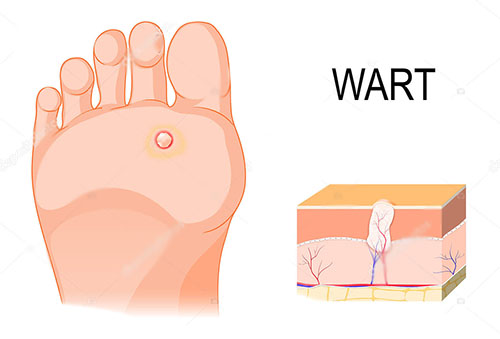 Hpv foot warts treatment Pancreatic cancer depression
